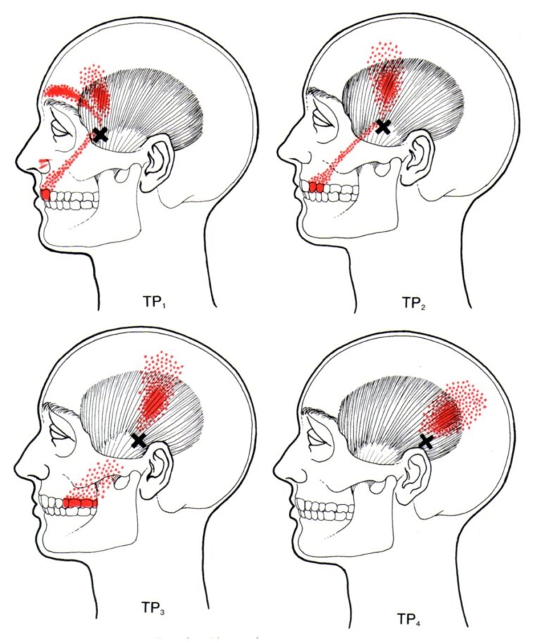 trigger-points