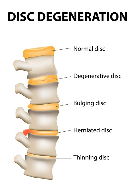 disc-degeneration-in-lower-back.jpg