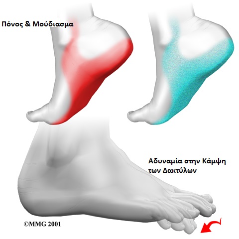 foot_tarsal_tunnel_causes02-Copy